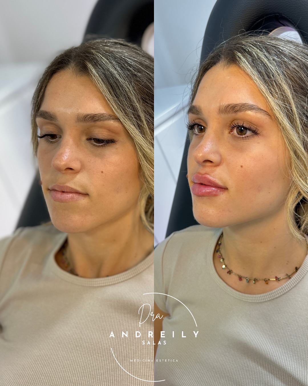 dra.andreilysalas Facebook ad: First-Time Lip Filler, Before & After