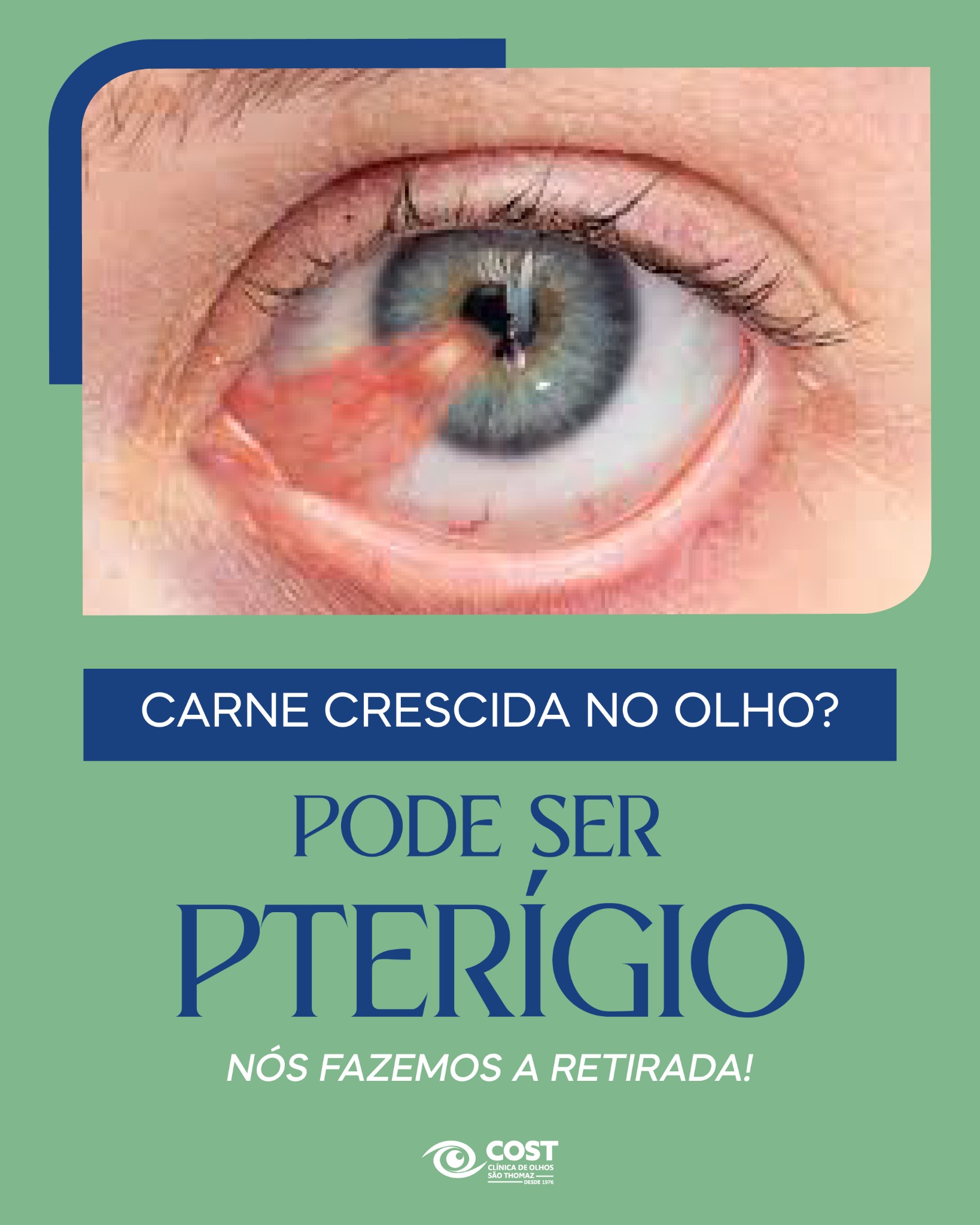 COST - Clínica de Olhos São Thomaz Facebook ad: O Pterígio, conhecido popularmente como carne no olho…