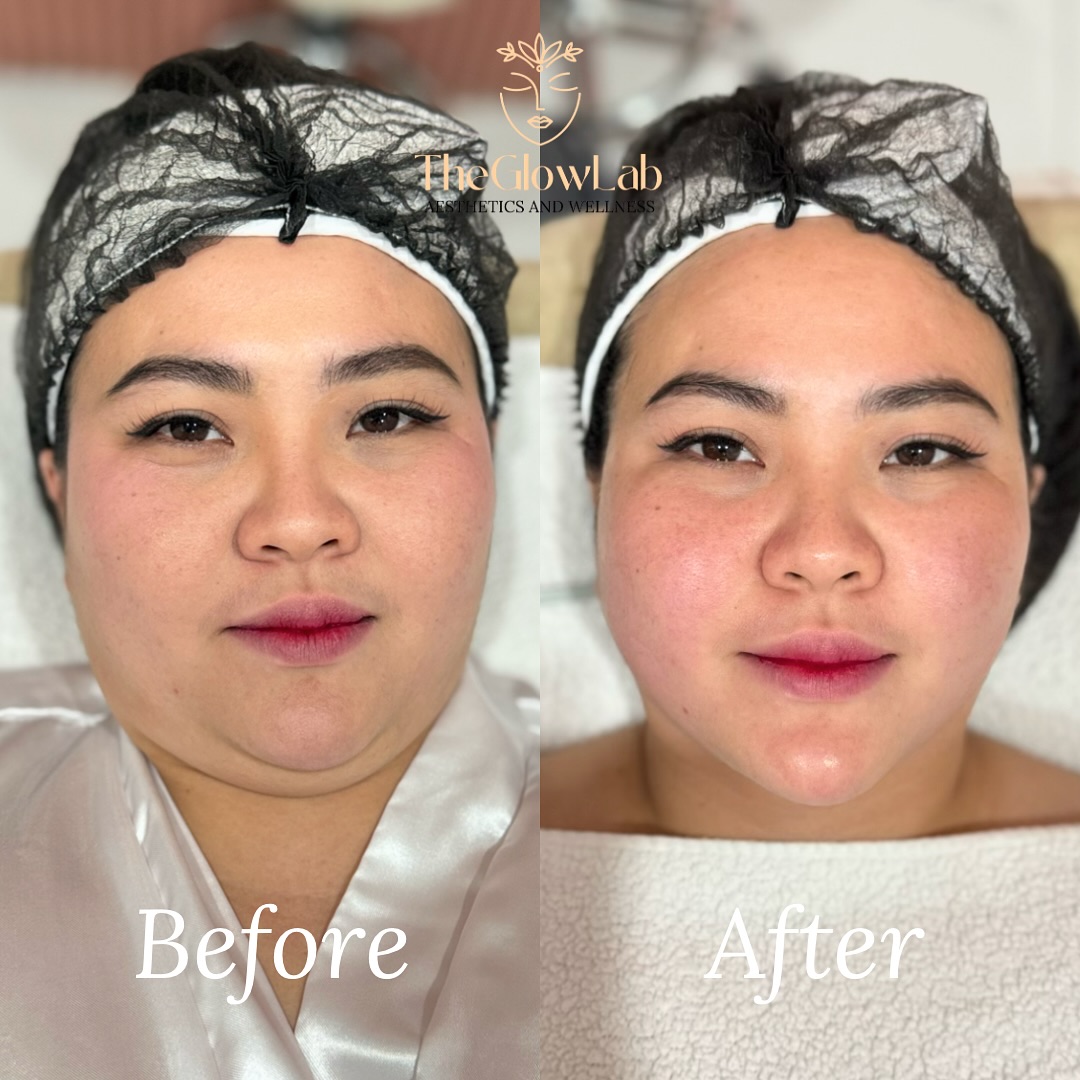 The Glow Lab Aesthetic and Wellness Clinic - Calamba, Laguna Facebook ad: 𝗕𝗼𝗼𝘀𝘁 𝗬𝗼𝘂𝗿 𝗦𝗸𝗶𝗻’𝘀 𝗥𝗮𝗱𝗶𝗮𝗻𝗰𝗲!