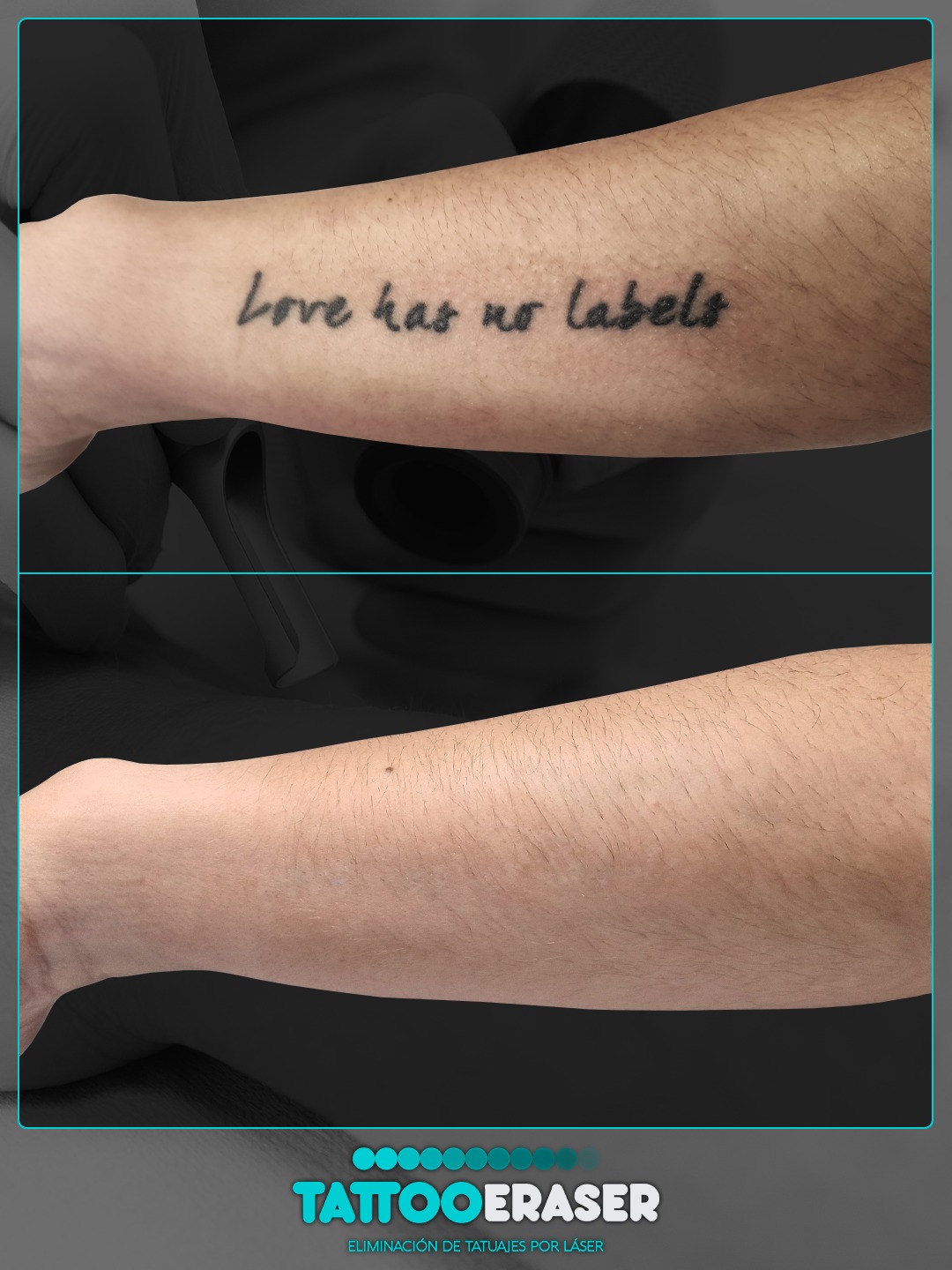 Tattoo Eraser Facebook ad: En esta comparativa mostramos el resultado final de…
