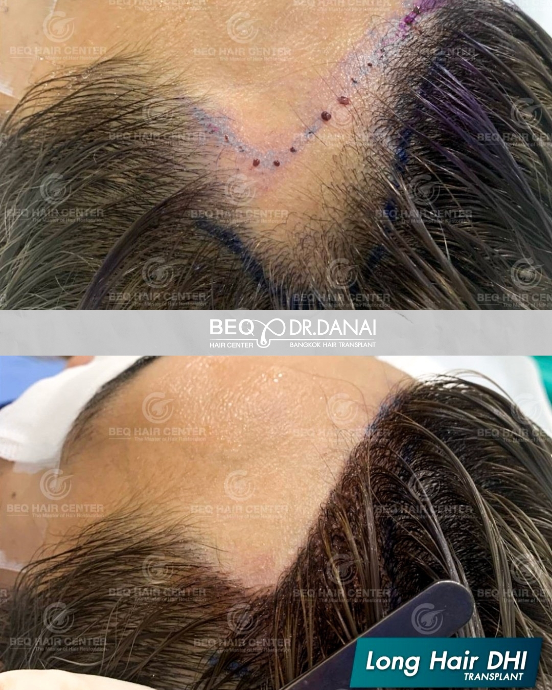 Dr. Danai Bangkok Hair Transplant ปลูกผมถาวร Facebook ad
