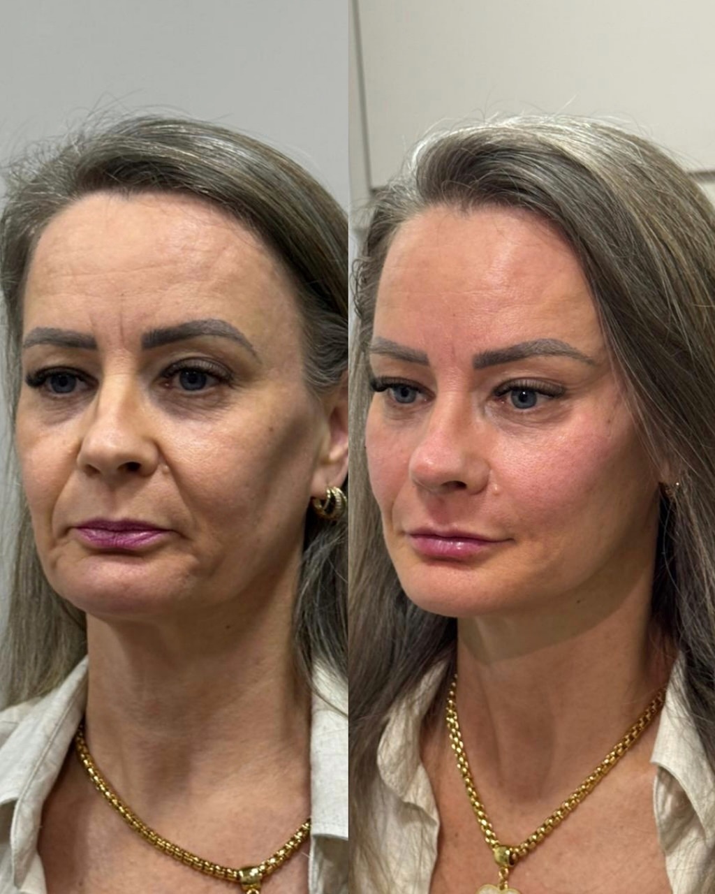 Cirurgiã-Dentista Verônica G. Rosseto Facebook ad: Essa é daquelas transformações que fazem o tempo…