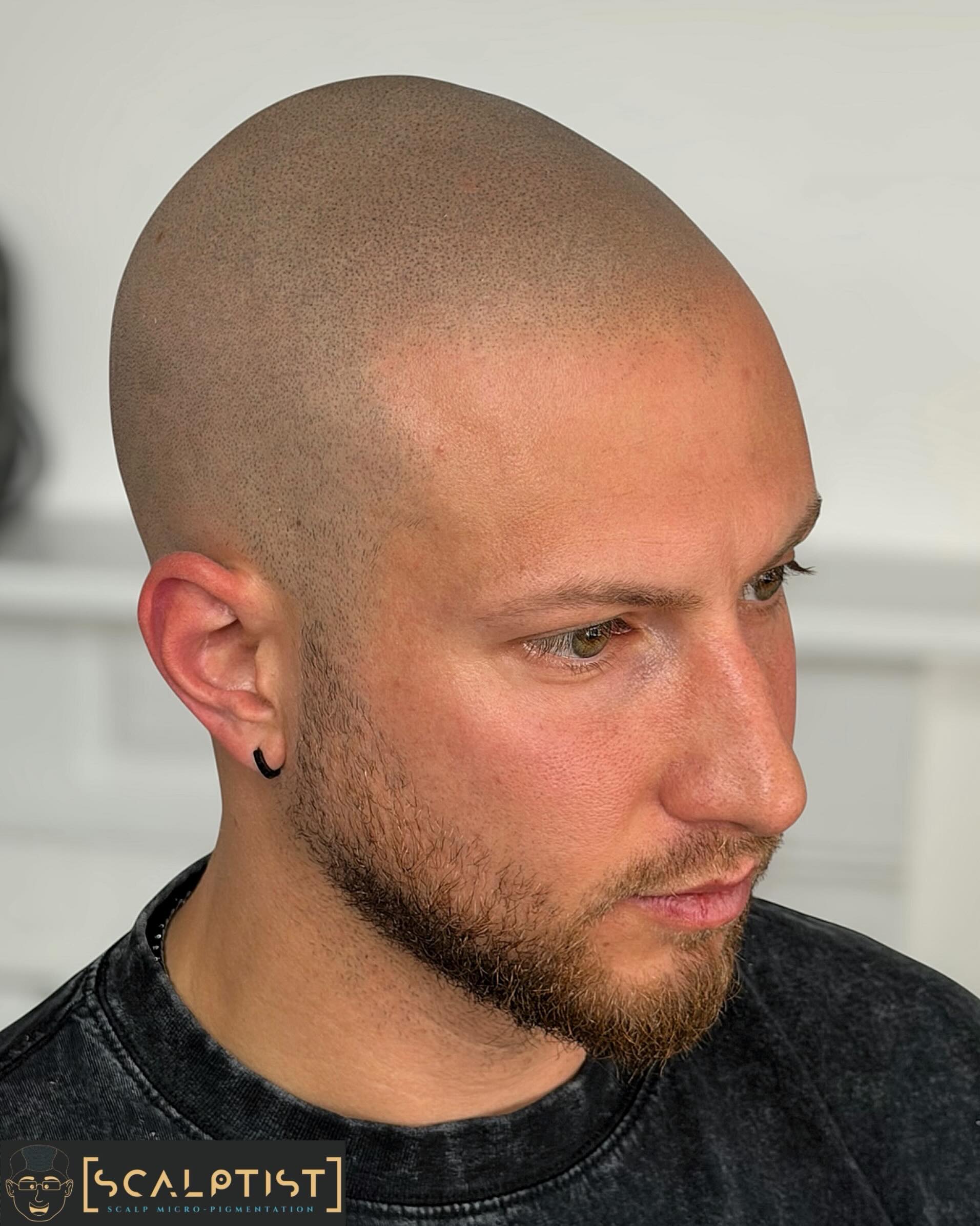 Scalptist Facebook ad: � Traveling the world for perfect hairline?