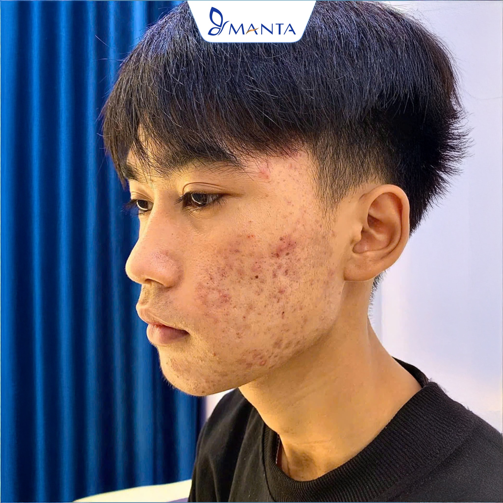 Viện Điều Trị Da Liễu Số 1 Hải Phòng - Manta Clinic Facebook ad: [BN4128 - Điều trị Mụn Viêm, Mụn Thâm…
