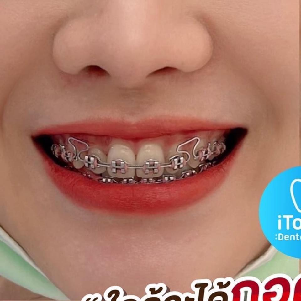 Itooth dental clinic ทันตกรรม ครบวงจร Facebook ad