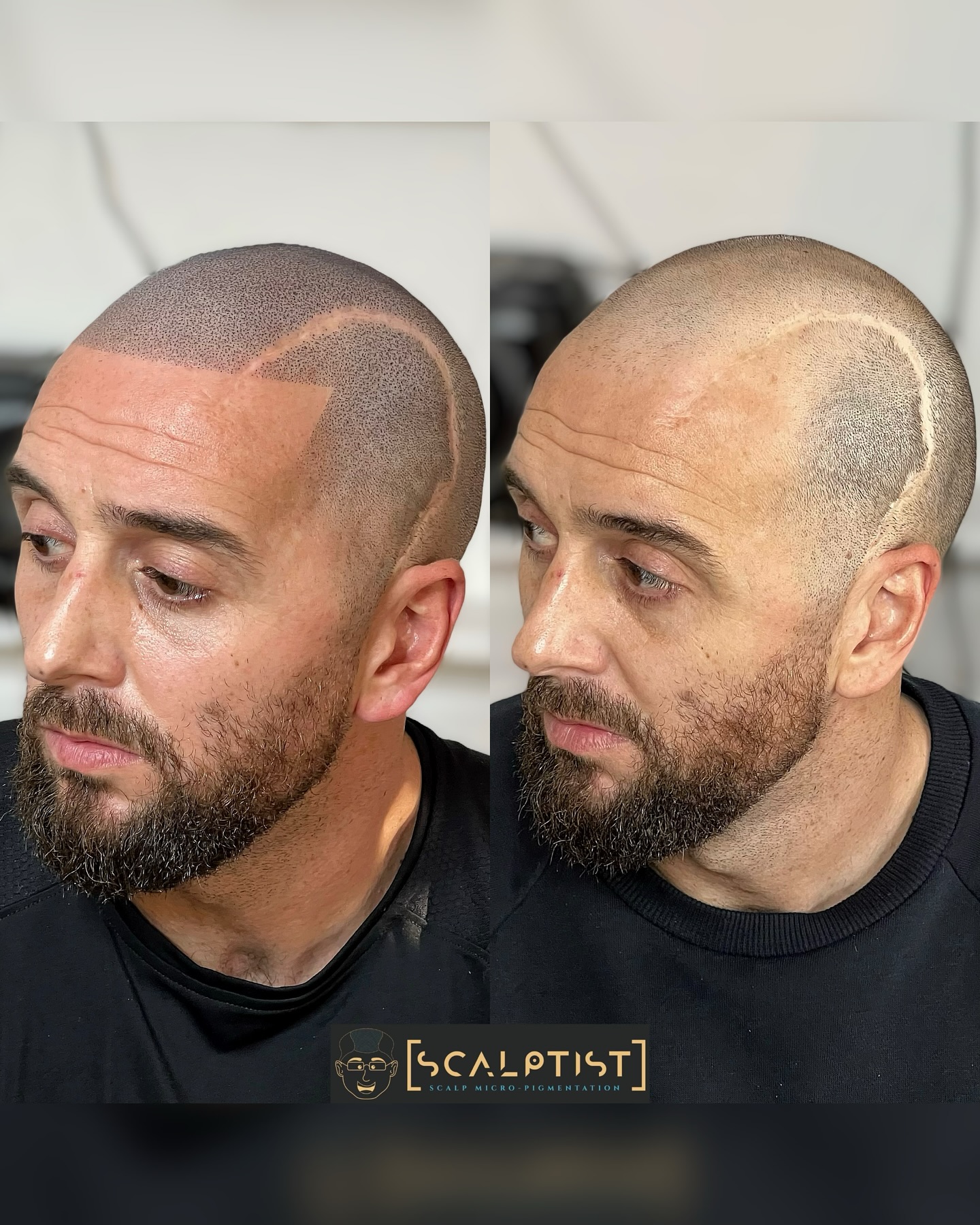 Scalptist Facebook ad: SCARS TELL A STORY, BUT BAD HAIRLINES DON'T…