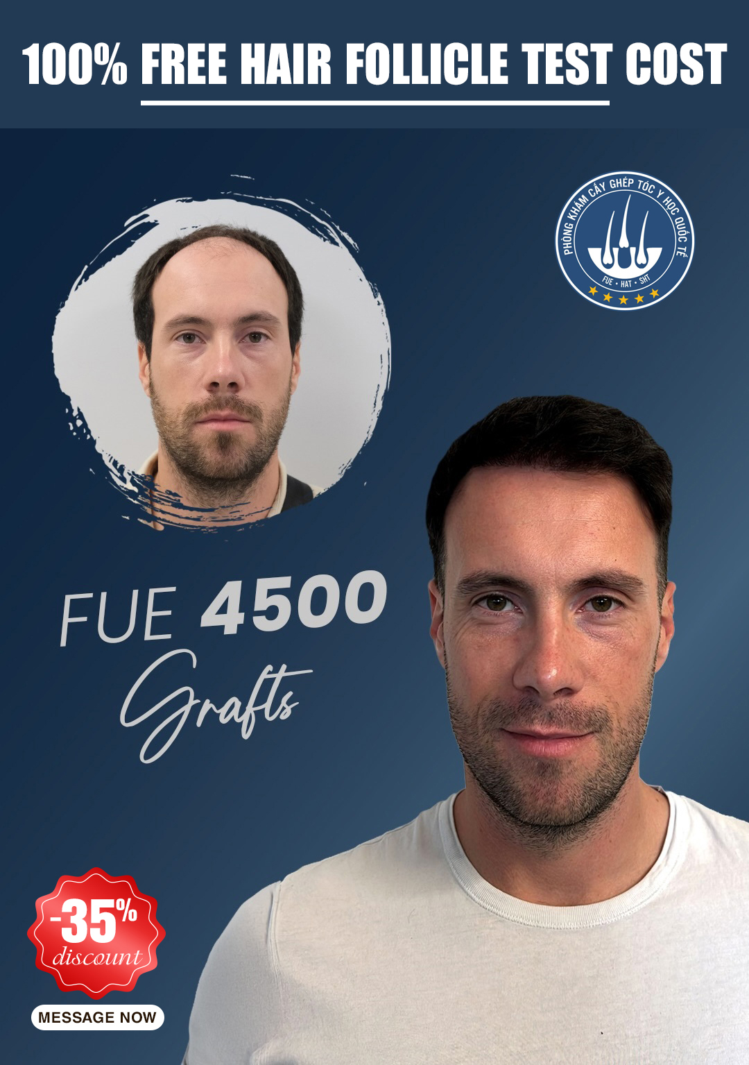 Hcm Hair Transplant Institute Facebook ad: 12 months ago, Paul decided to take the…