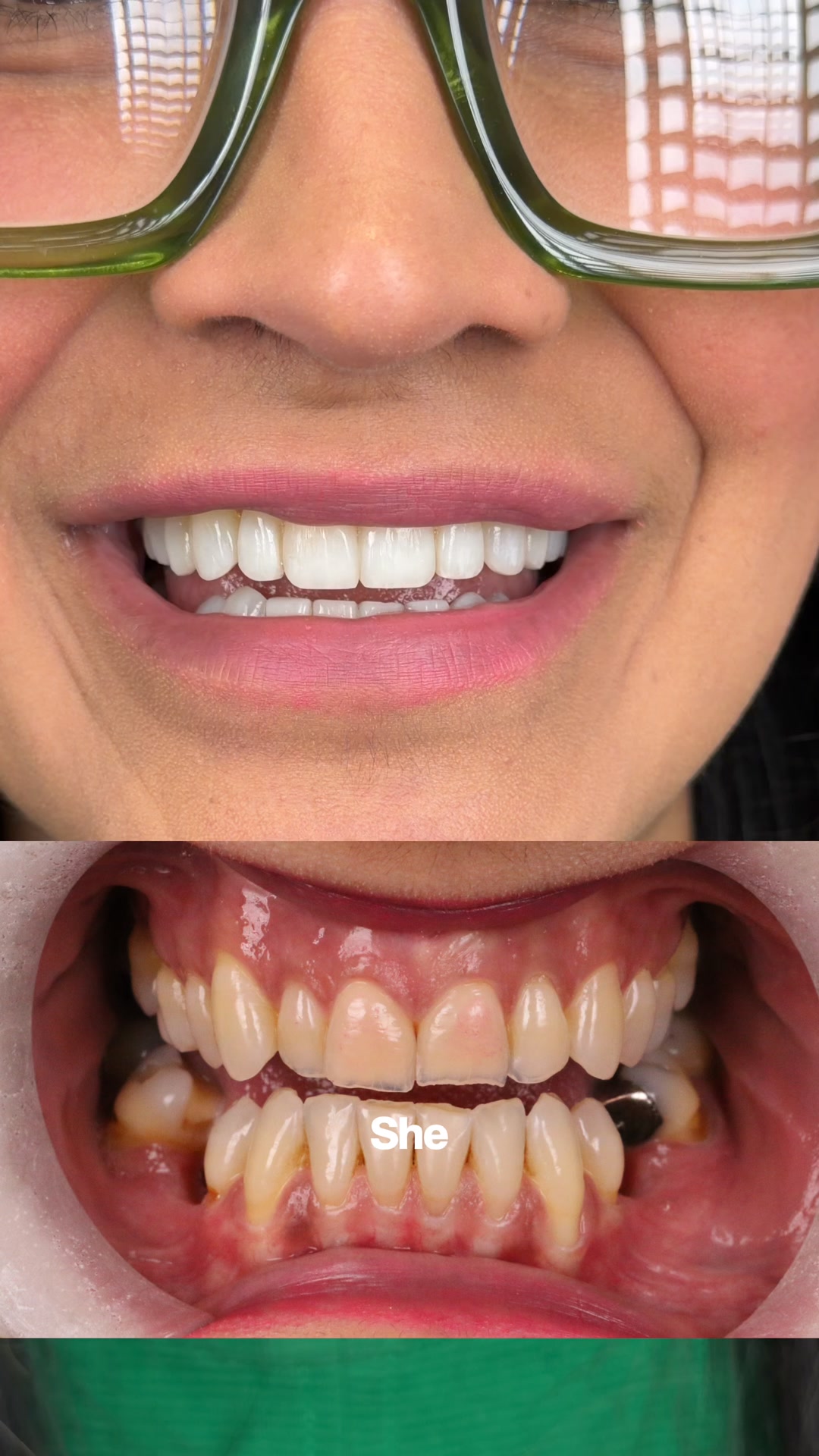 LUME dental Facebook ad: Unlock Your Best Smile Without Fear or Embarrassment