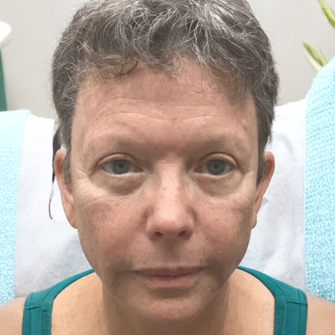 Dr. Maja Björkman Facebook ad: Min läkare sa att påsar under ögonen bara är en del av…