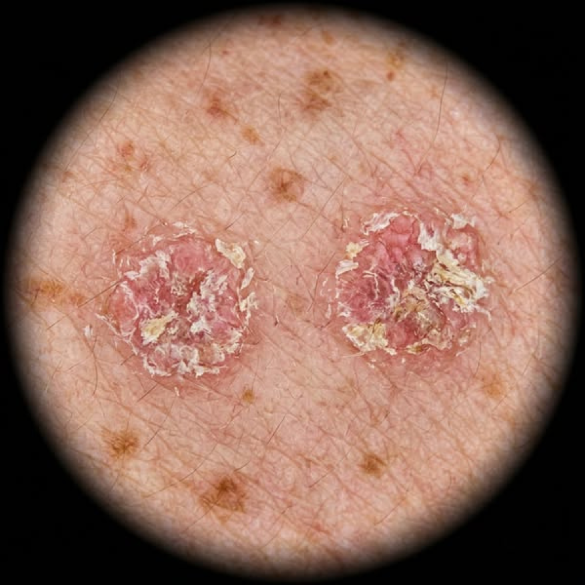 Lauren Sterling Facebook ad: Actinic Keratosis Actually Has 4 Stages. Most Treatments…