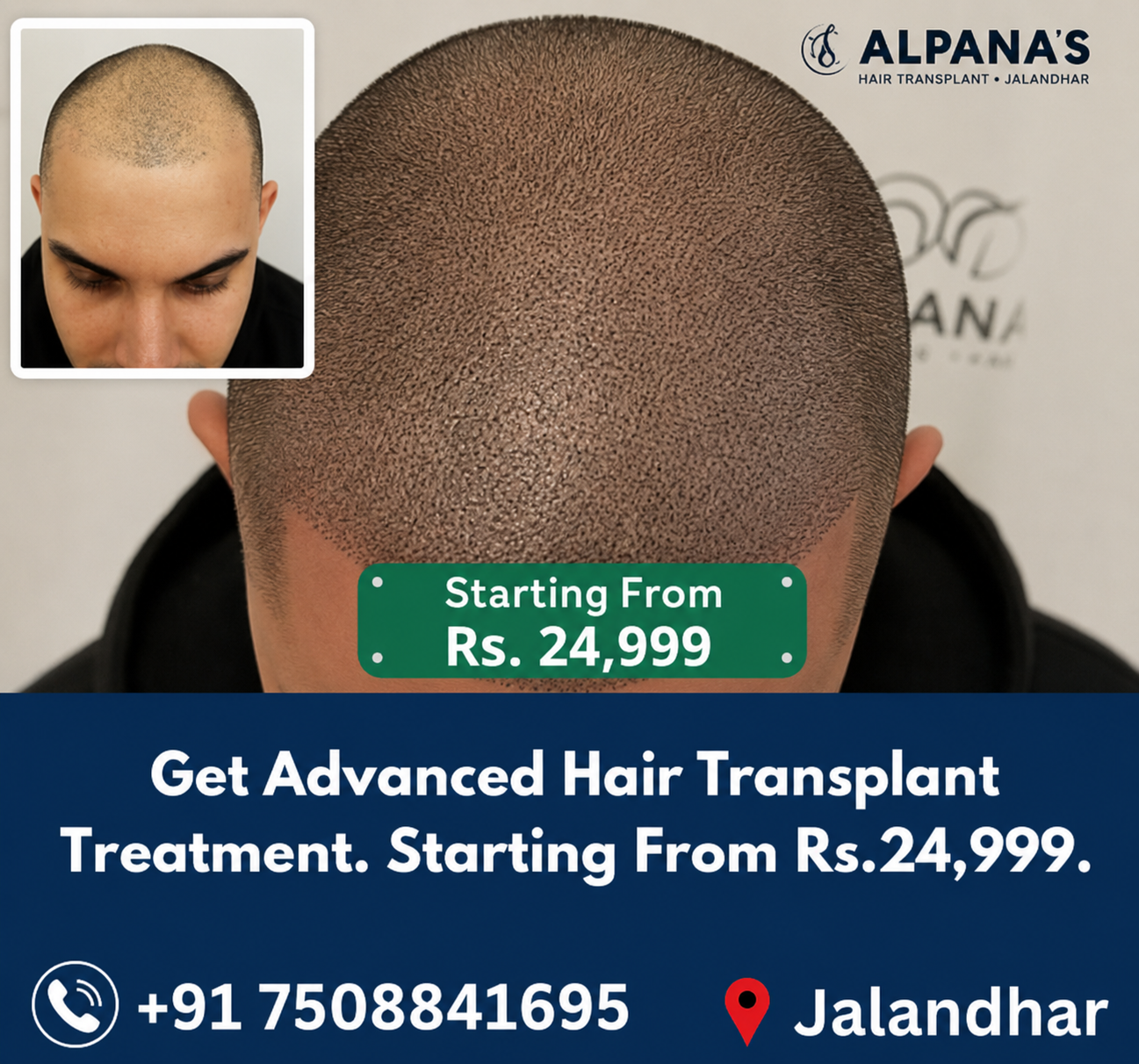 Alpana's Hair Treatment Clinic Facebook ad: Get best hair transplant treatment at Alpana's hair…