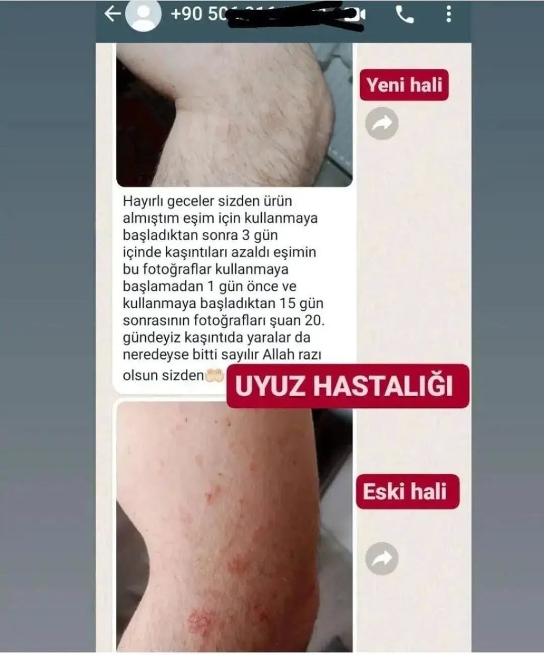 Uyuz Kaşıntı Spreyi Facebook ad: KESIN ÇÖZÜM VE GARANLİ UYUZ SPREYİ