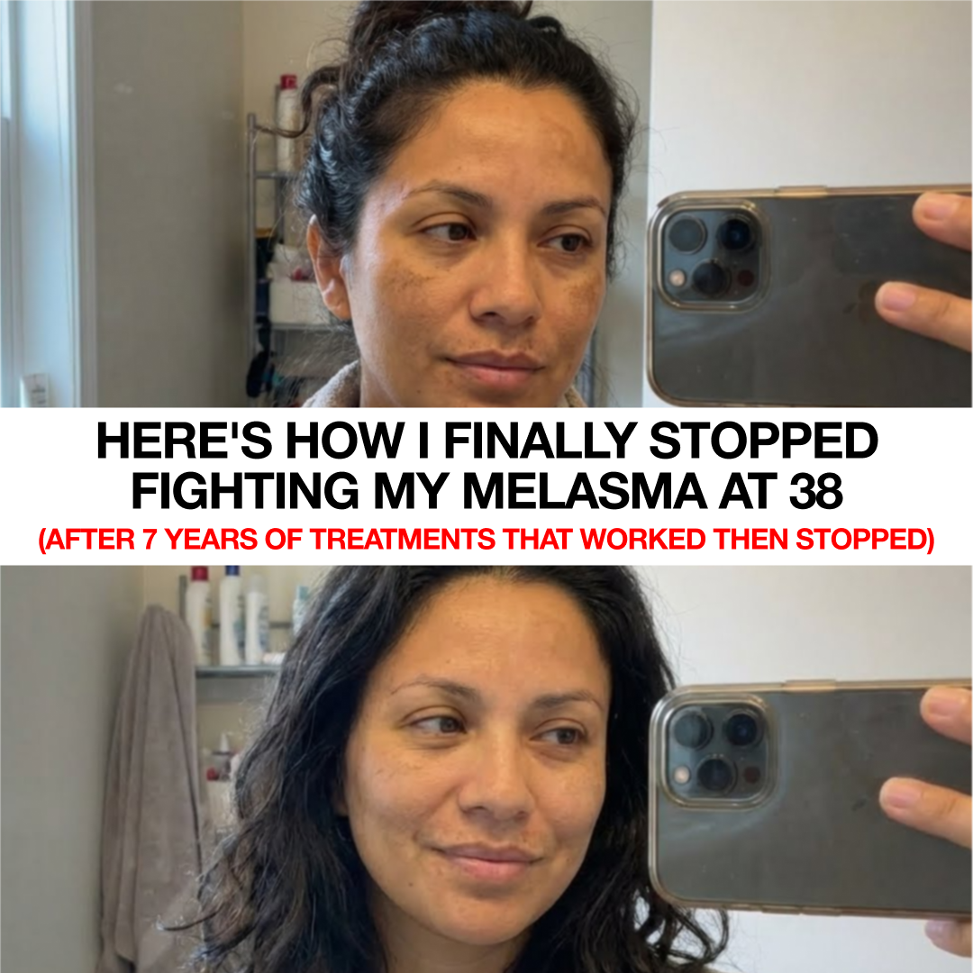 OMIC+ Skincare Facebook ad: If you suffer from melasma read this