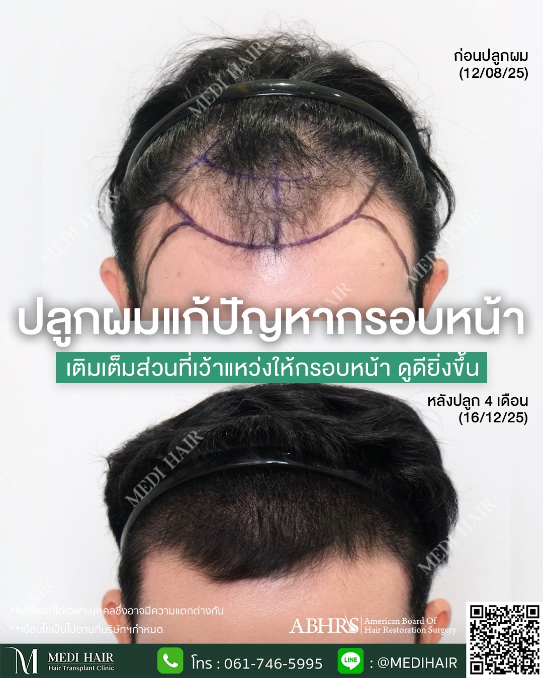 MEDI HAIR Facebook ad