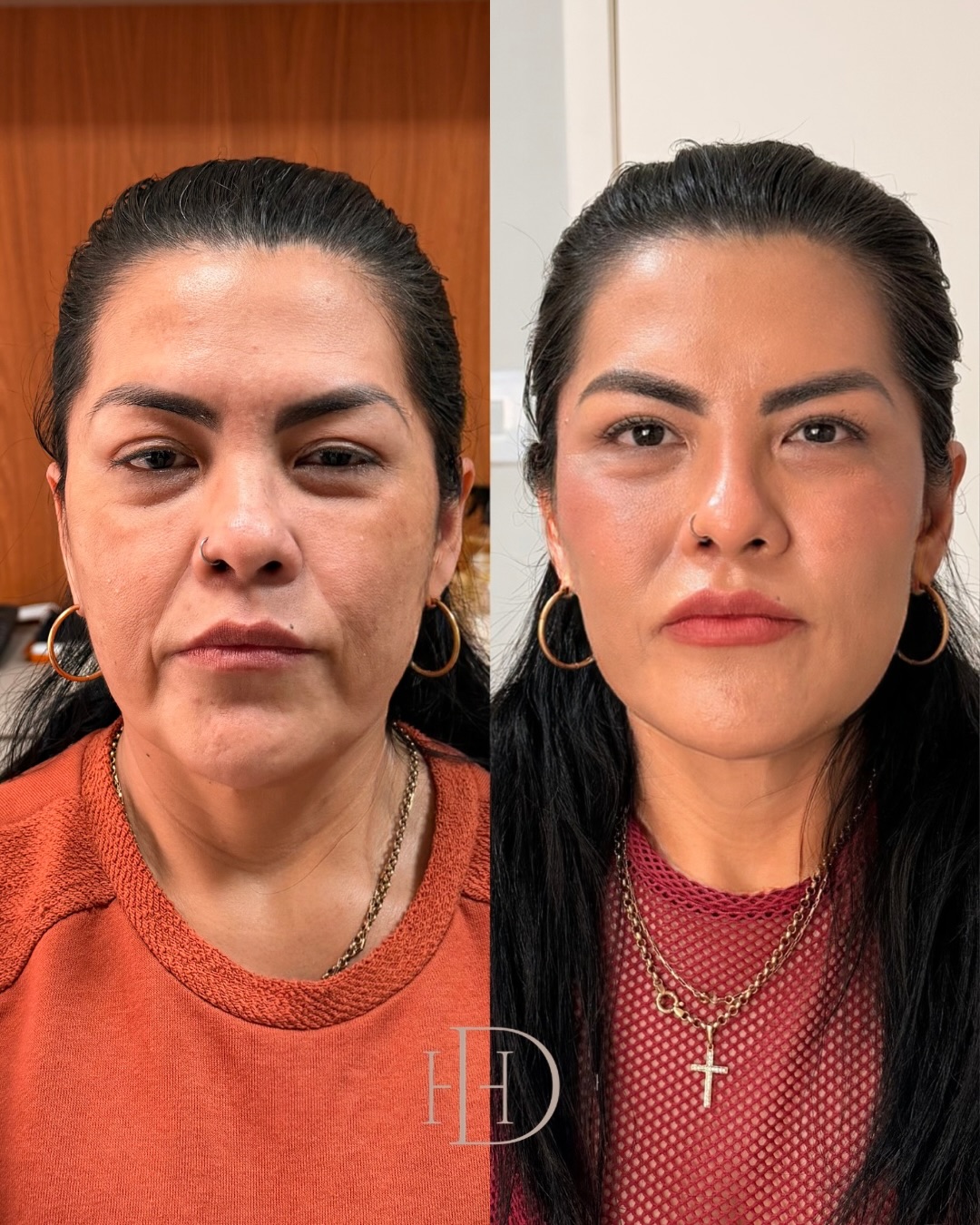 Haline Darmanceff - HOF Facebook ad: Nem todo emagrecimento rejuvenesce o rosto.