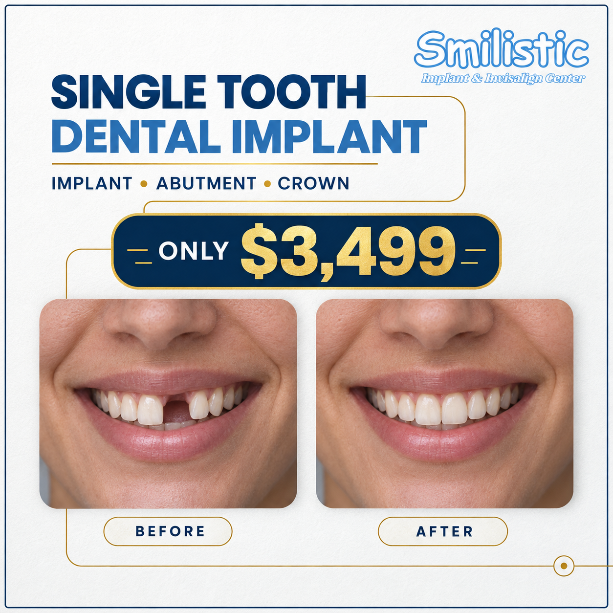 Smilistic Dental Care of Marlborough Facebook ad: Marlborough - Single Tooth Implants at $3,499!