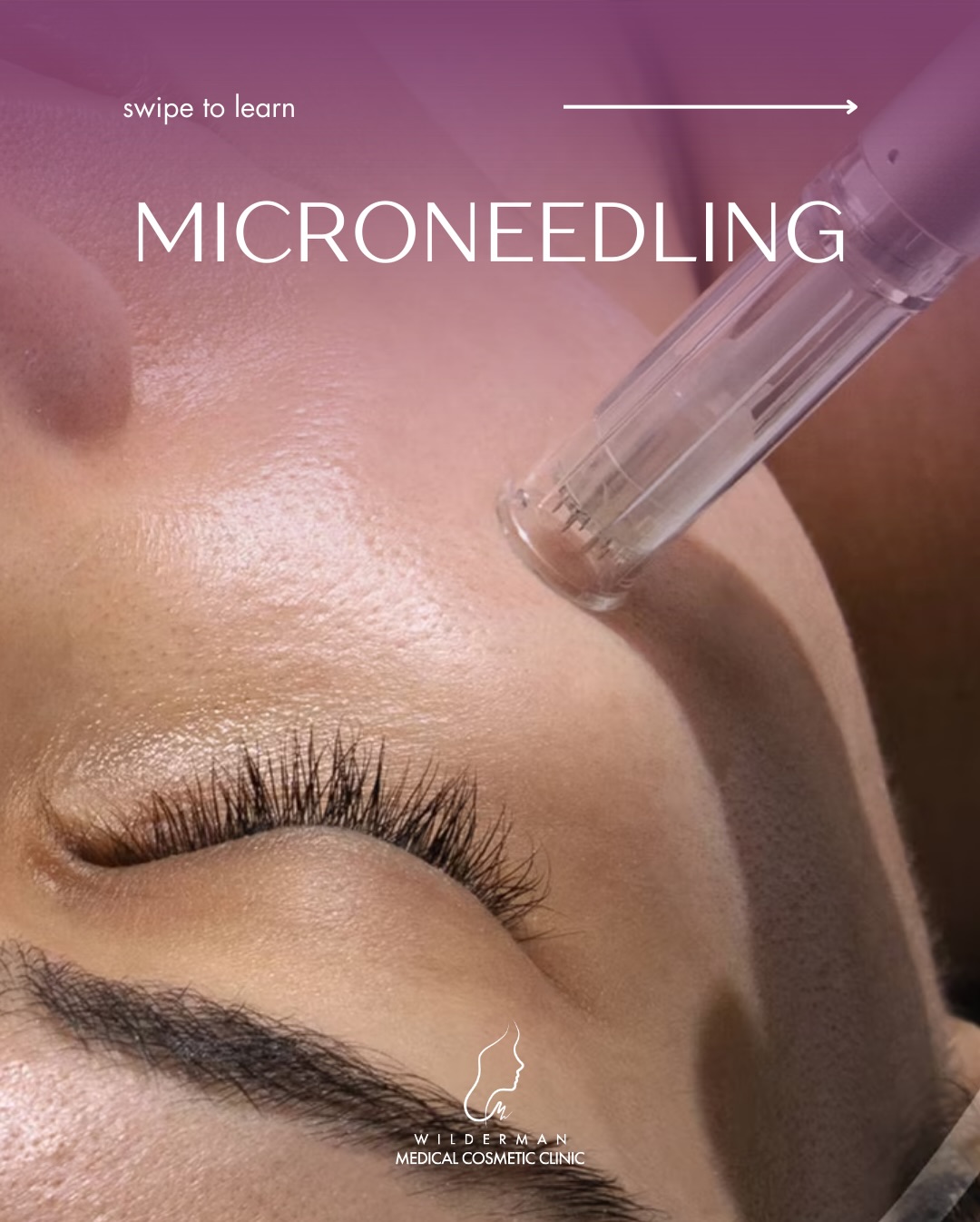 Wilderman Cosmetic Clinic Facebook ad