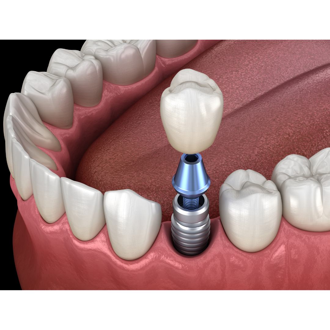 Village Dental-Claycomo & KC Dental ER Facebook ad