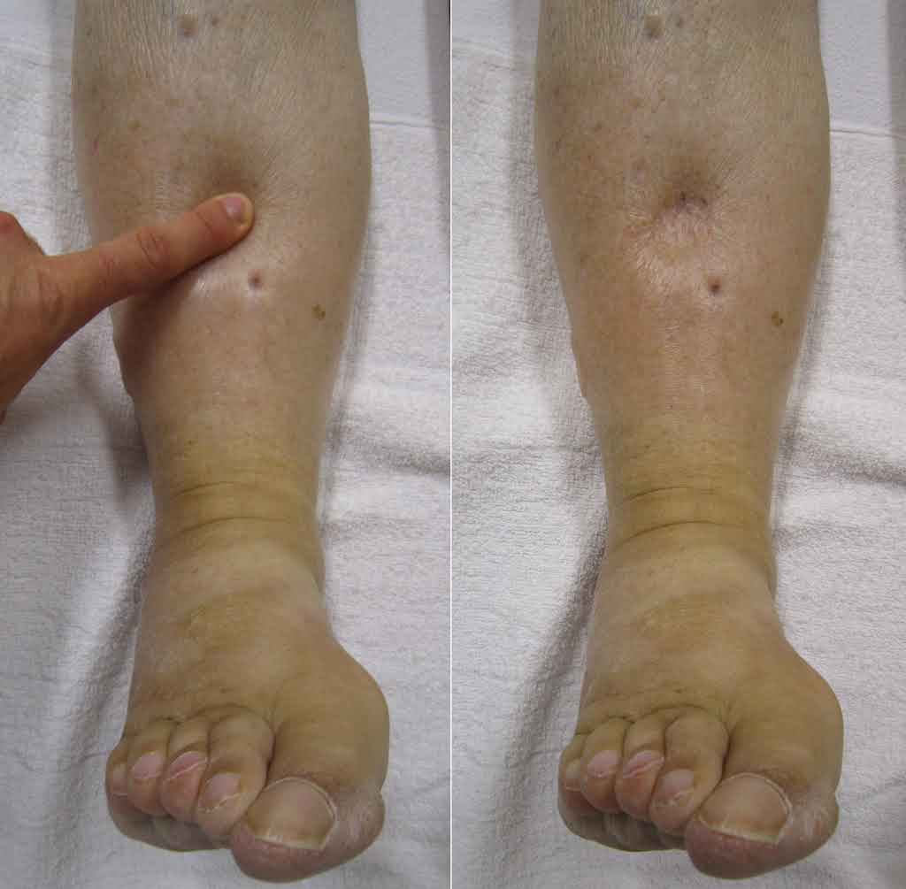 Lymphologist Dr. Nancy Snyderman, MD Facebook ad