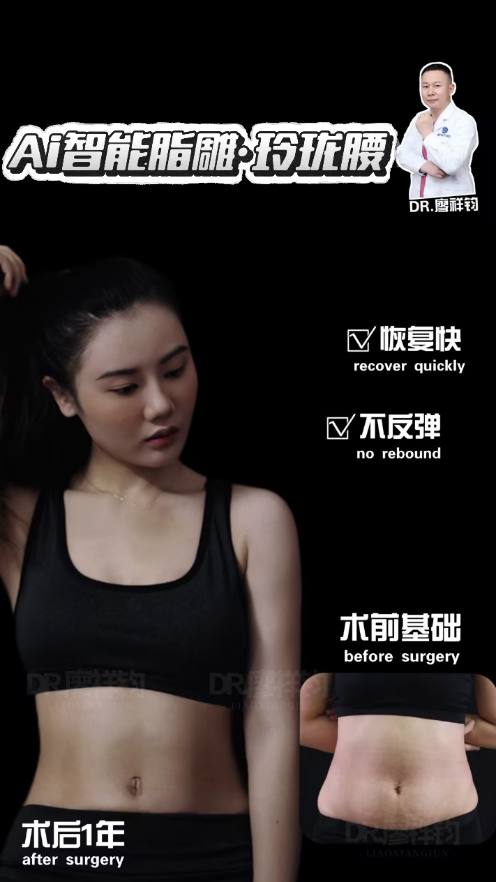 廖祥鈞-脂肪体雕整形专家-深圳富華医院 Facebook ad: 腰上的贅肉終於有救了!