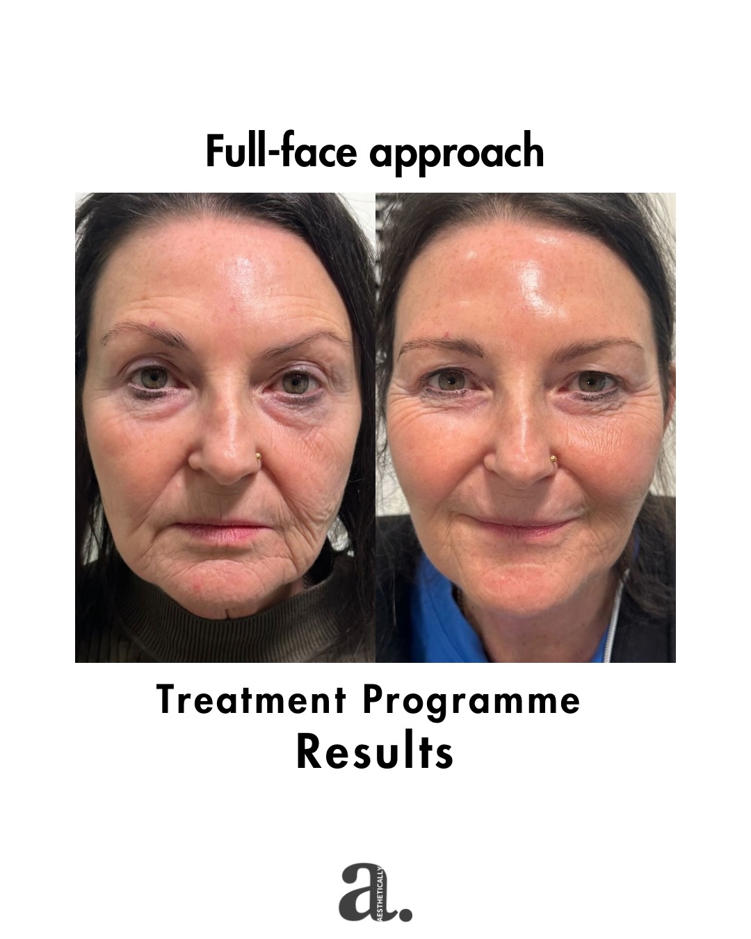 Aestheticallyuk Facebook ad: Full-face approach. Treatment programme results.
