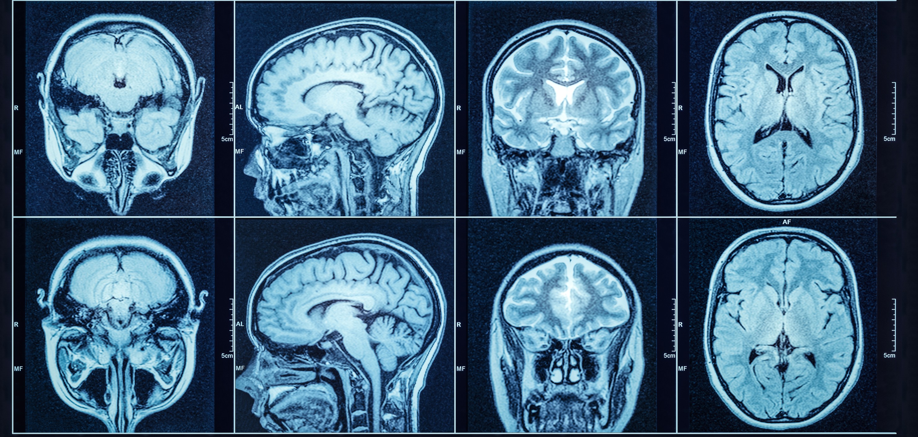 Subcortical Cognitive Dysfunction Laboratory Facebook ad: Healthy Participants for Brain Injury Research
