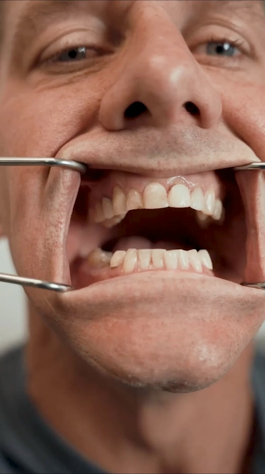 Nuvia Dental Implant Center Facebook ad: New Permanent Teeth Are Just 24 Hours Away!