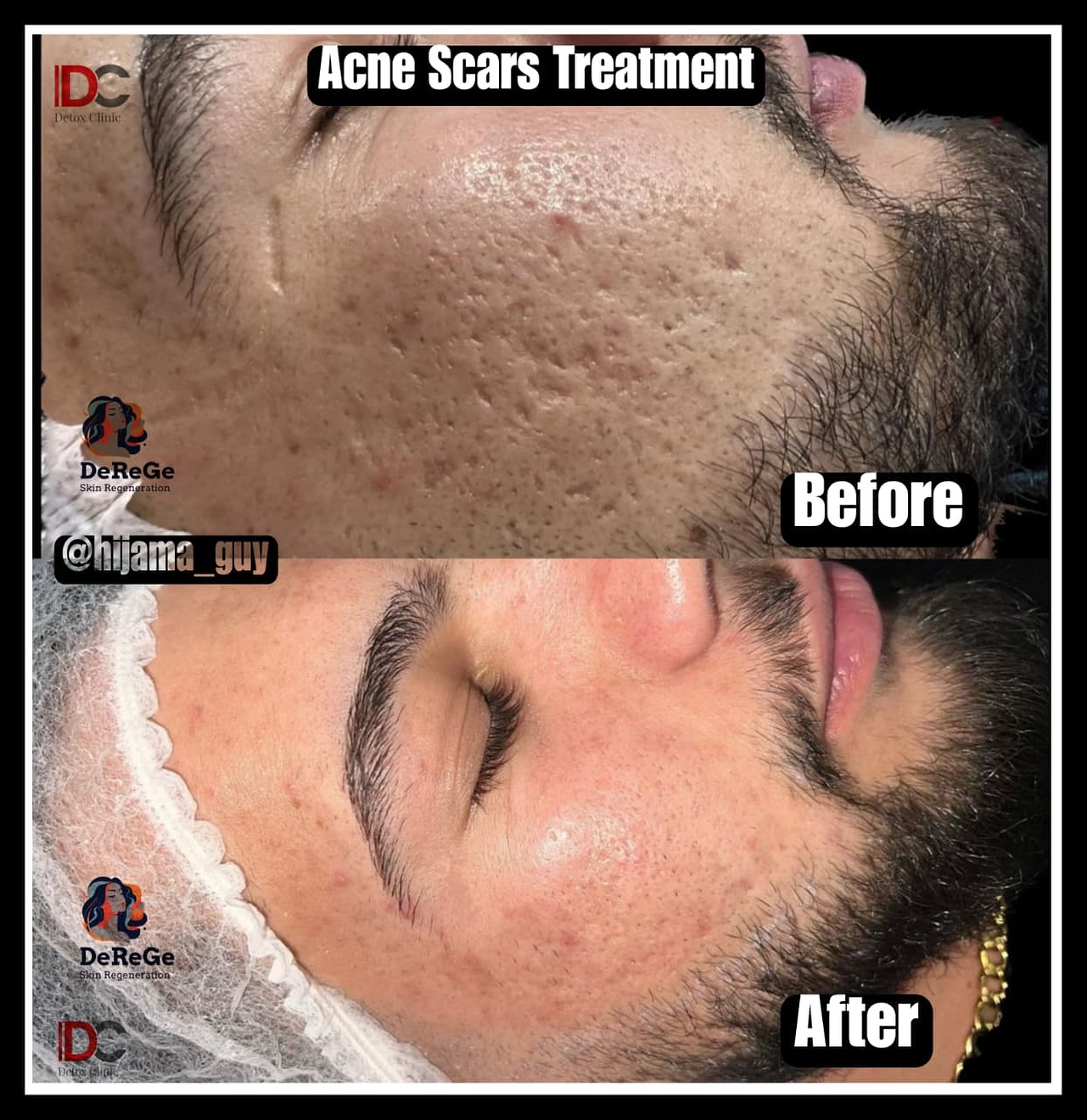 Detox Clinic Facebook ad: Successful Results Of Acne Scars By DeGeRe Treatment