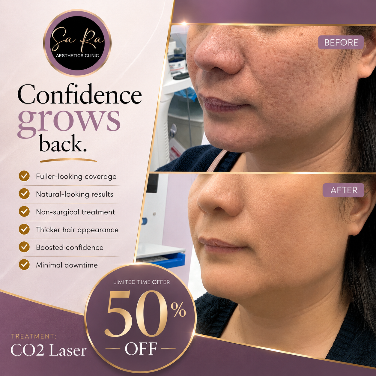Sara Aesthetic Clinic. Facebook ad: 50% OFF CO2 Ablative Laser, Smooth, Clear, Renew