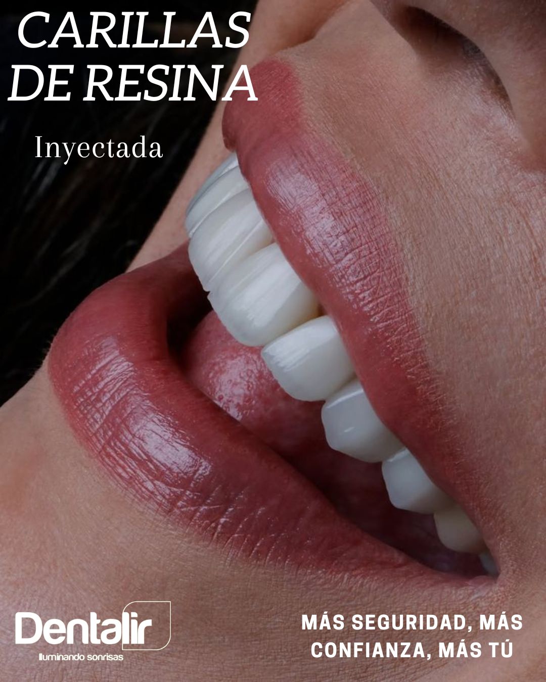 Dentalir Facebook ad: Carillas de Resina Inyectada