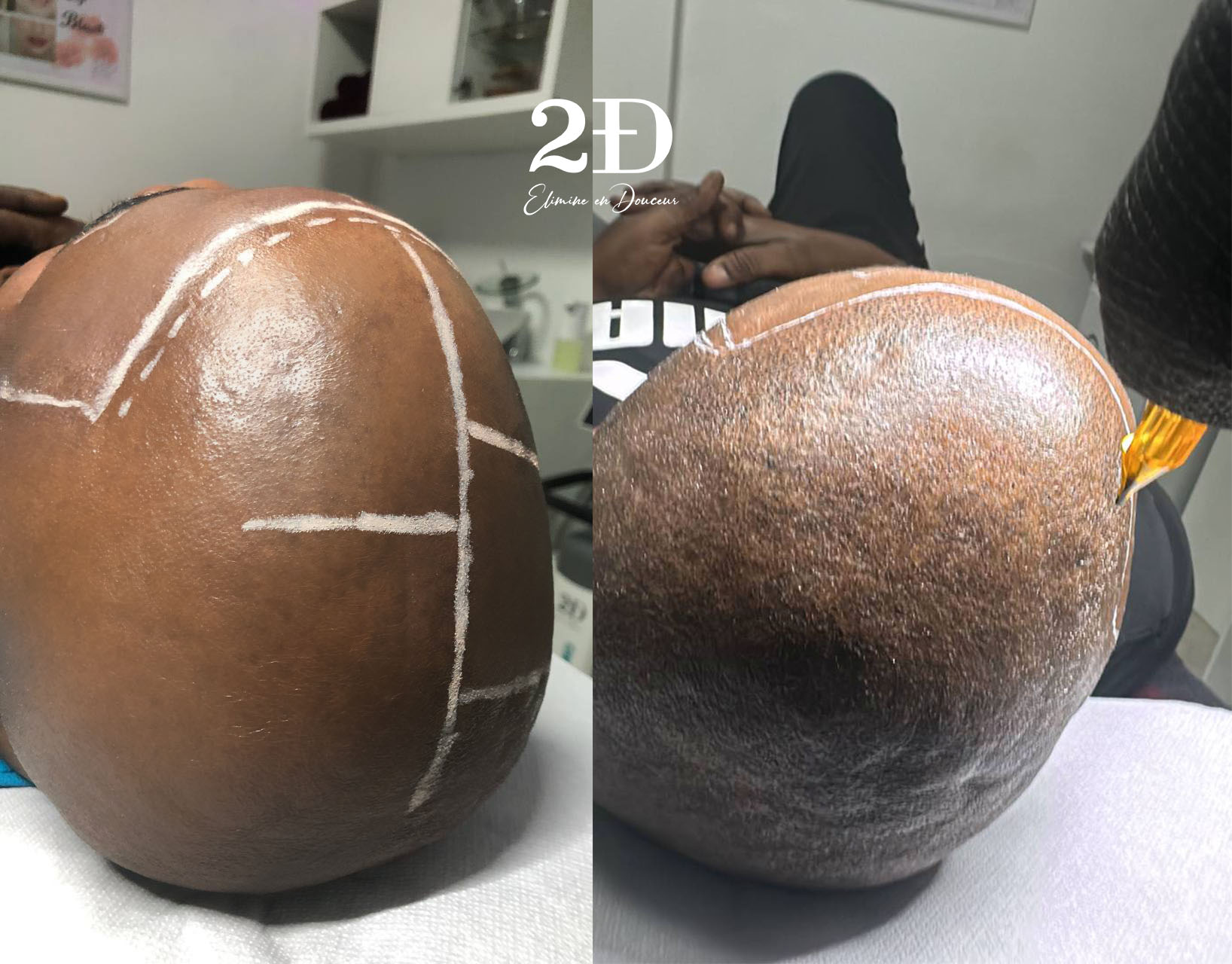 Micropigmentation-bruxelles Facebook ad: Vous souhaitez opter pour la tricopigmentation, la…