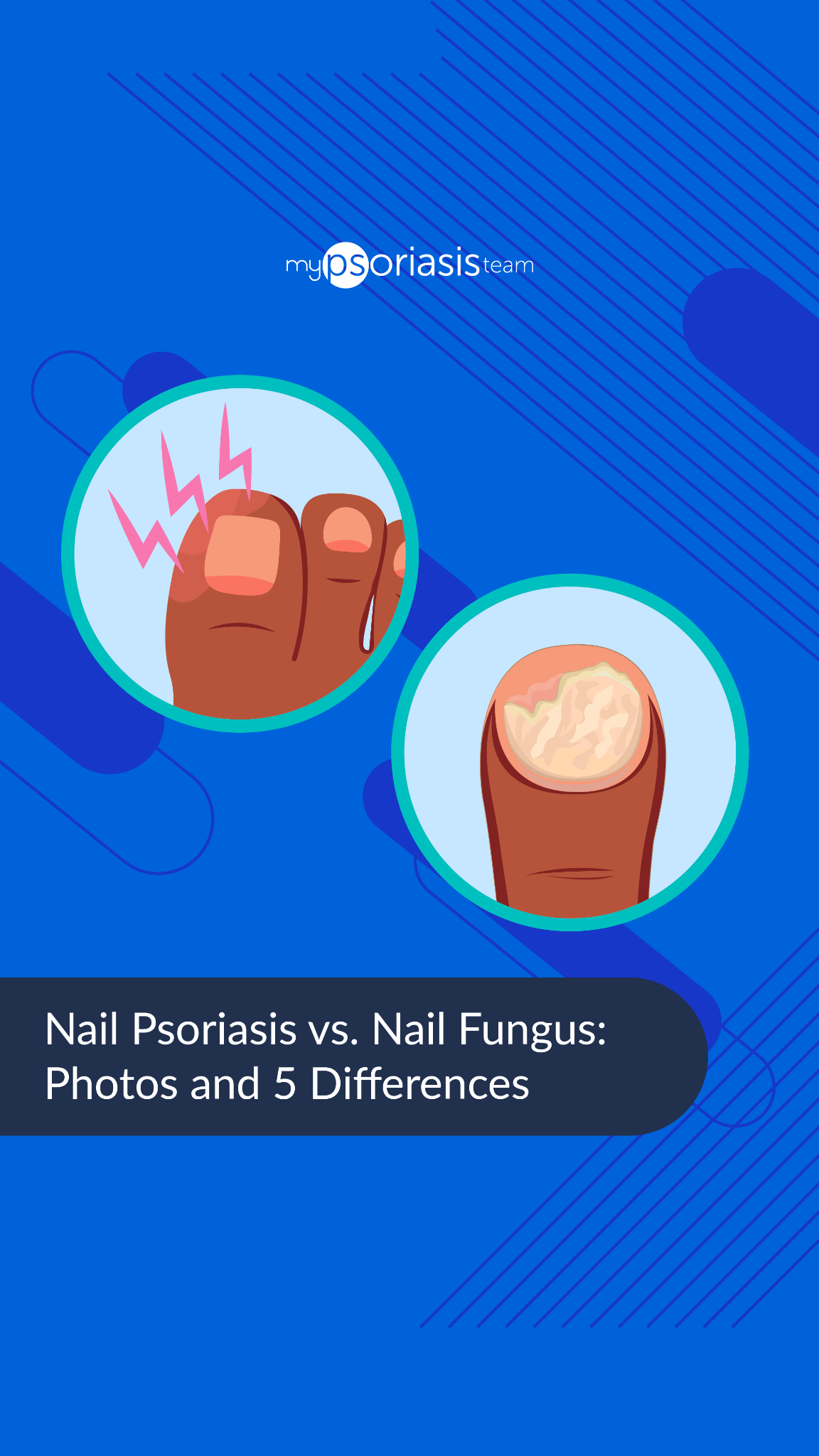MyPsoriasisTeam Facebook ad from Apr 1, 2026
