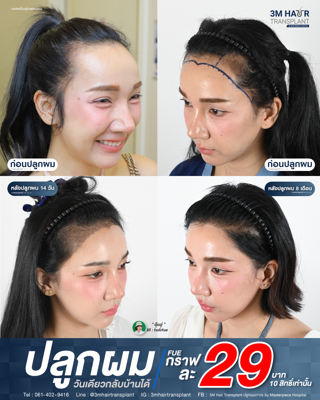 3M Hair Transplant ปลูกผมถาวร by Masterpiece Hospital Facebook ad