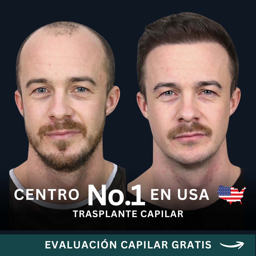 Hair Transplant Design Facebook ad