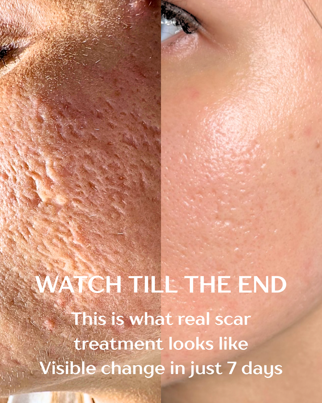 Acne Clinic NYC: Acne, Pigmentation, and Scars Treatment Facebook ad