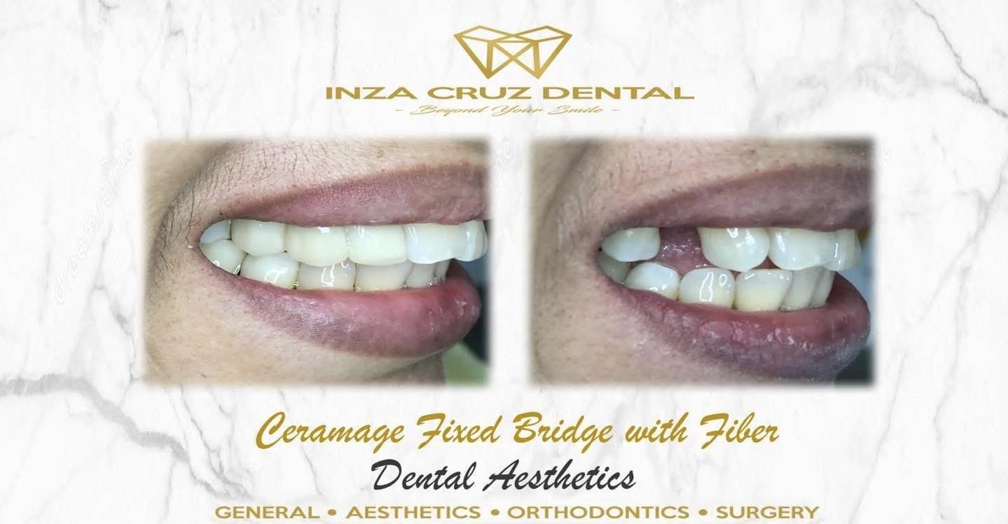 Inza Cruz Dental San Fernando-New Page Facebook ad: INZA CRUZ DENTAL: SAN FERNANDO BRANCH