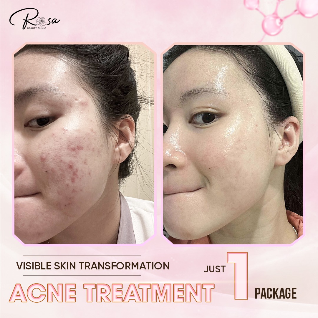 Rosa Beauty Clinic Facebook ad: ACNE TREATMENT, MEDICAL-GRADE SOLUTION FOR CLEAR SKIN