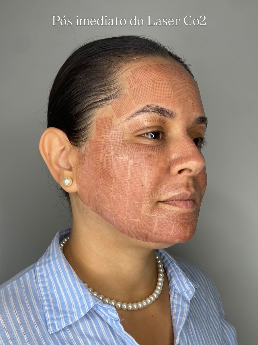 Beauty Estética Corpo e Face Facebook ad: Laser CO₂ para renovar a pele: melhora textura…