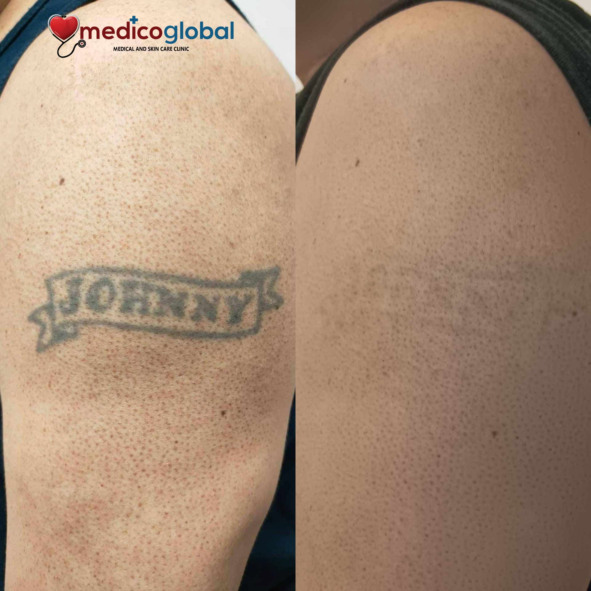 Medico Global Clinic Timog Ave. QC Branch - Medical and Skin Care Clinic Facebook ad: May kasabihan dati: Mag-isip muna bago magpa-tattoo.