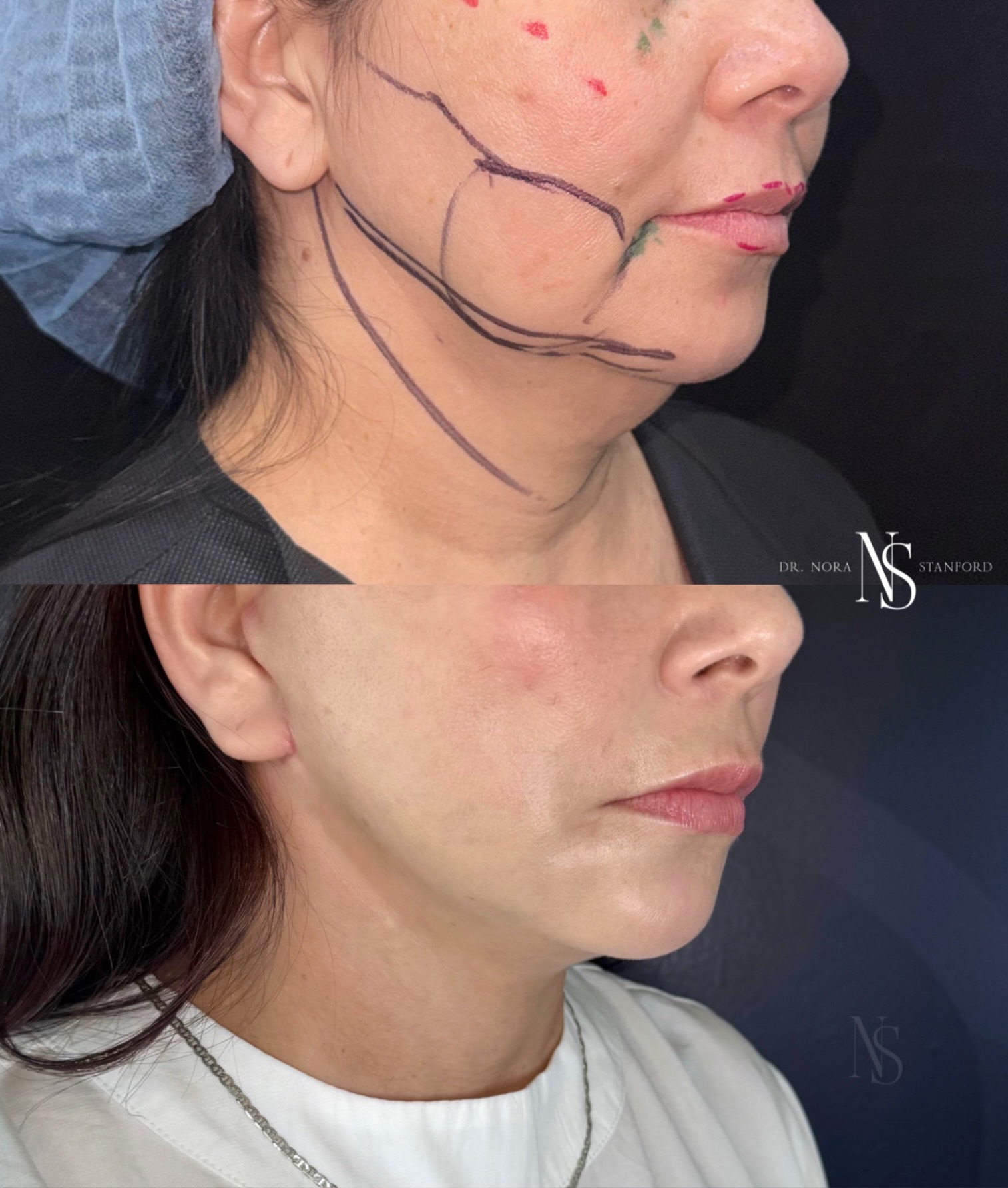 Dranorastanfordsurgery Facebook ad: La belleza de un TDL (tunneled deep lift)…