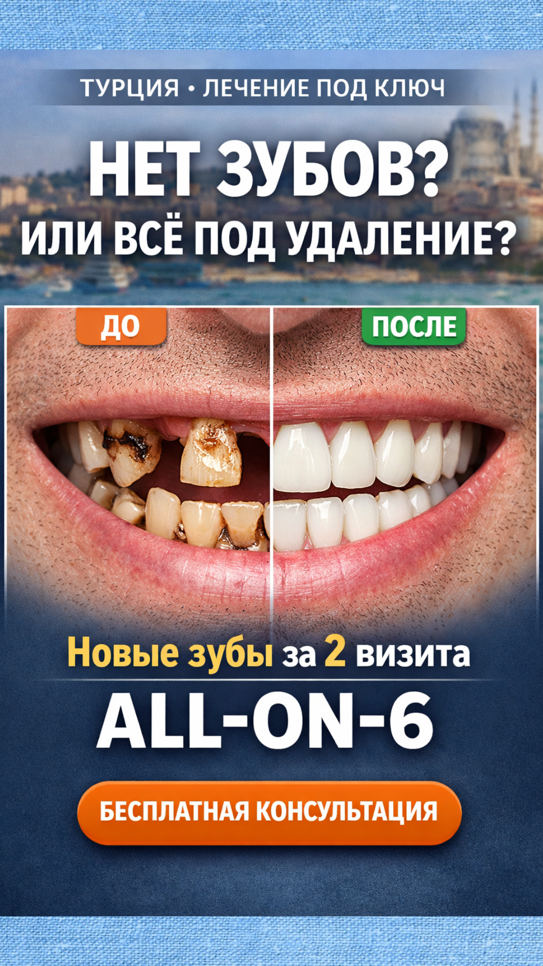 Diş Mimarisi Facebook ad: ALL on 4/ ALL on 6