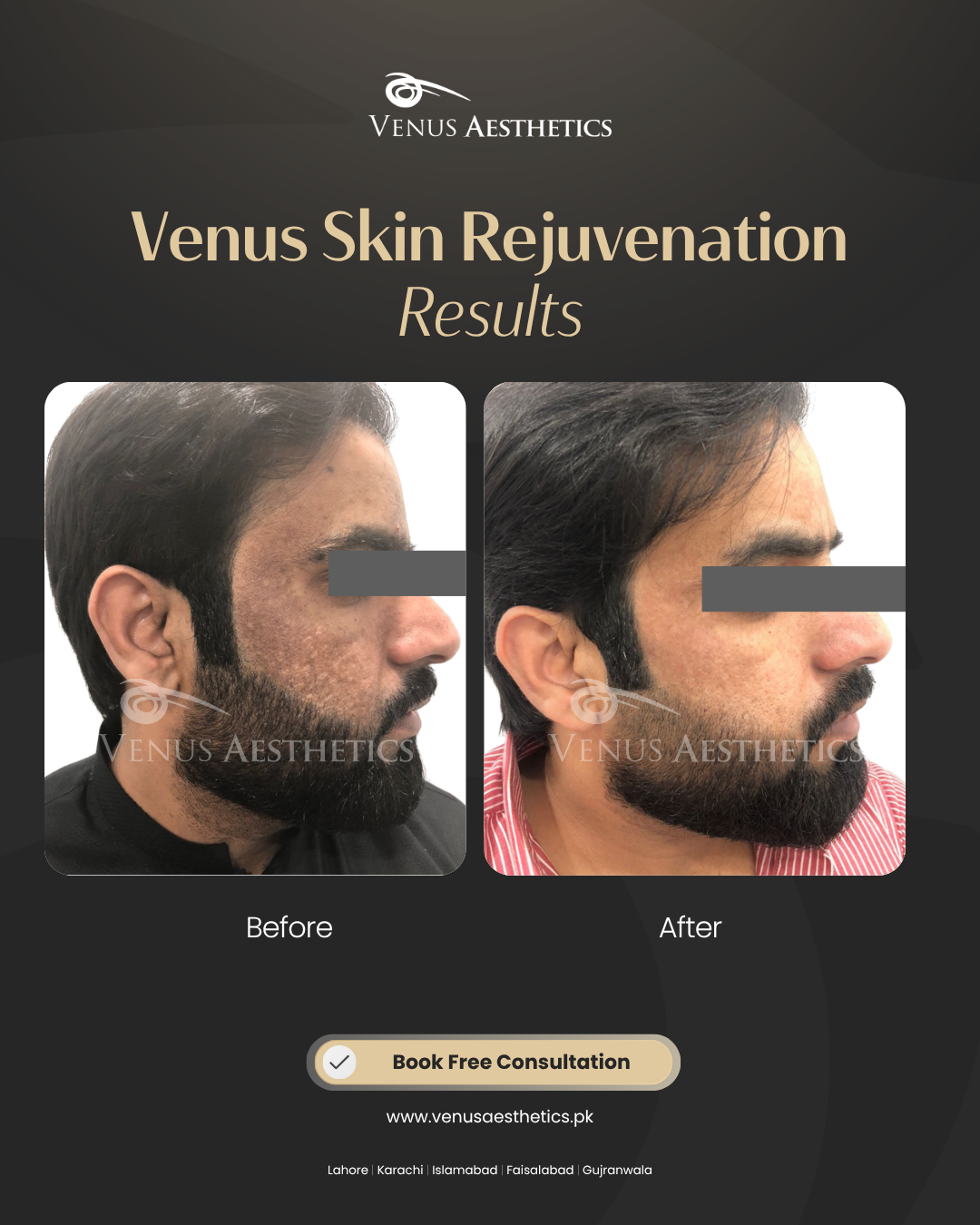 Venus Aesthetics Facebook ad