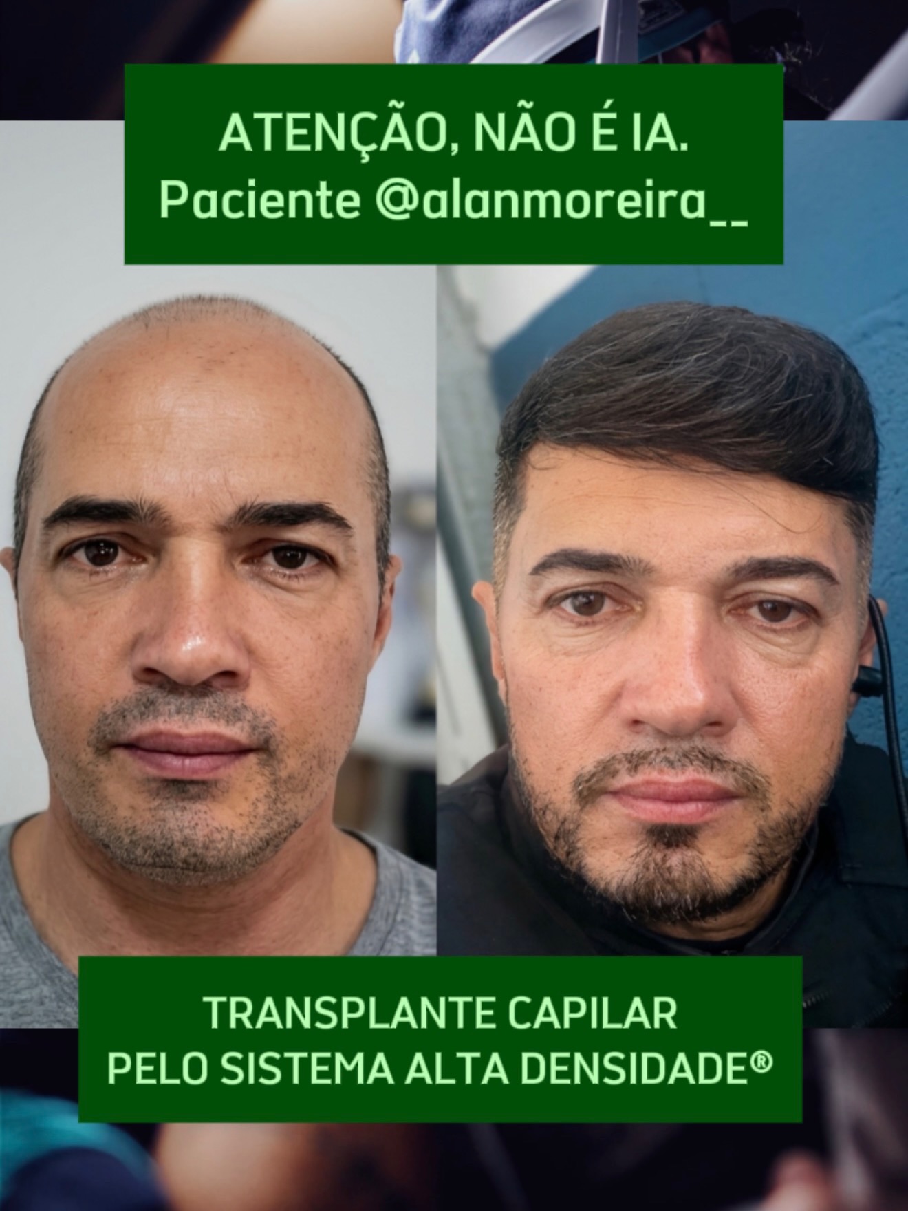 Grupo Capilar Brasil Facebook ad: IMPRESSIONANTE RESULTADO DO NOSSO PACIENTE alanmoreira_…