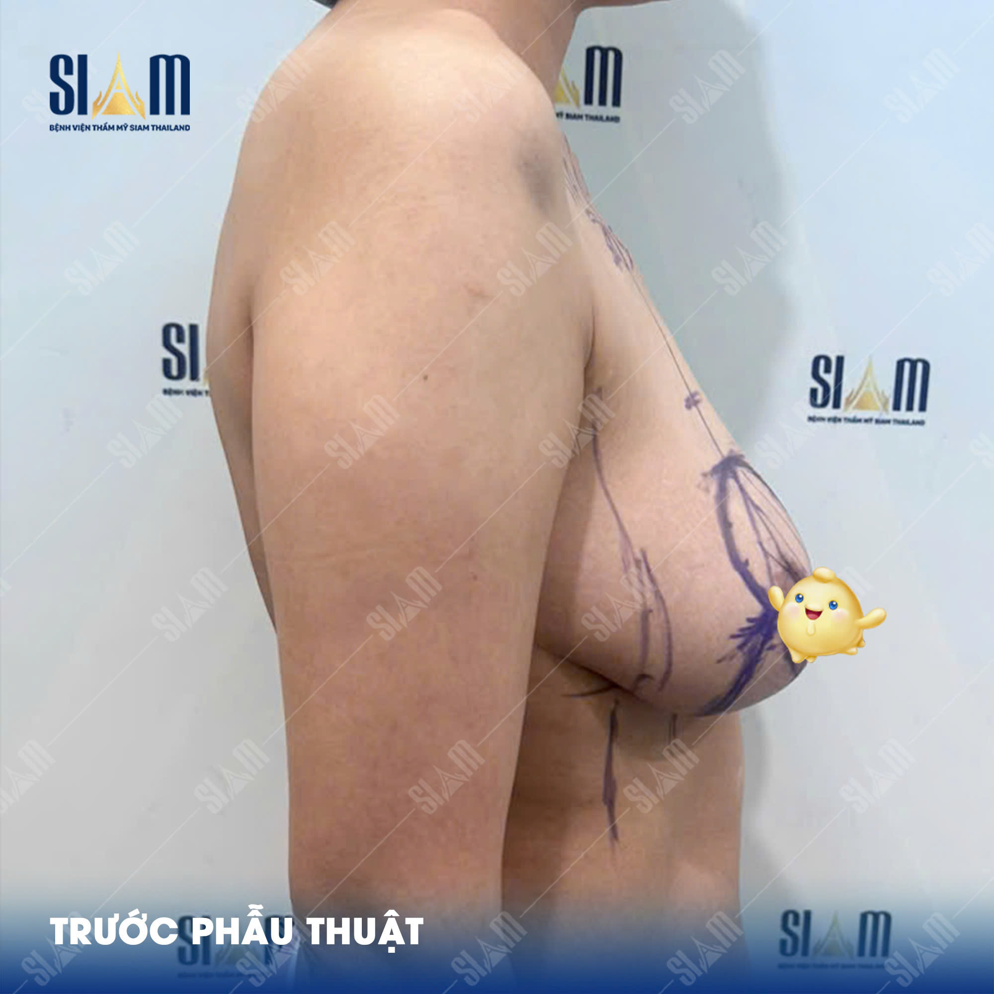 Treo sa trễ BRC - Bệnh Viện Thẩm Mỹ SIAM Thailand Facebook ad: SAU 15 NGÀY TREO SA TRỄ, ĐƯỜNG SẸO…