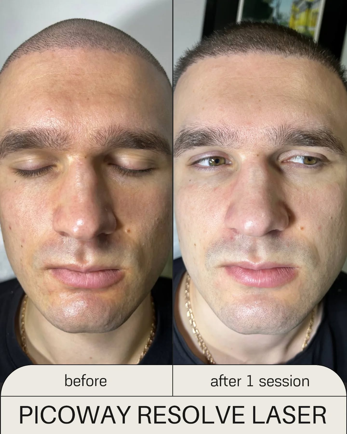 Dr. Melda Özekinci Facebook ad: PicoWay Resolve Laser | Antalya