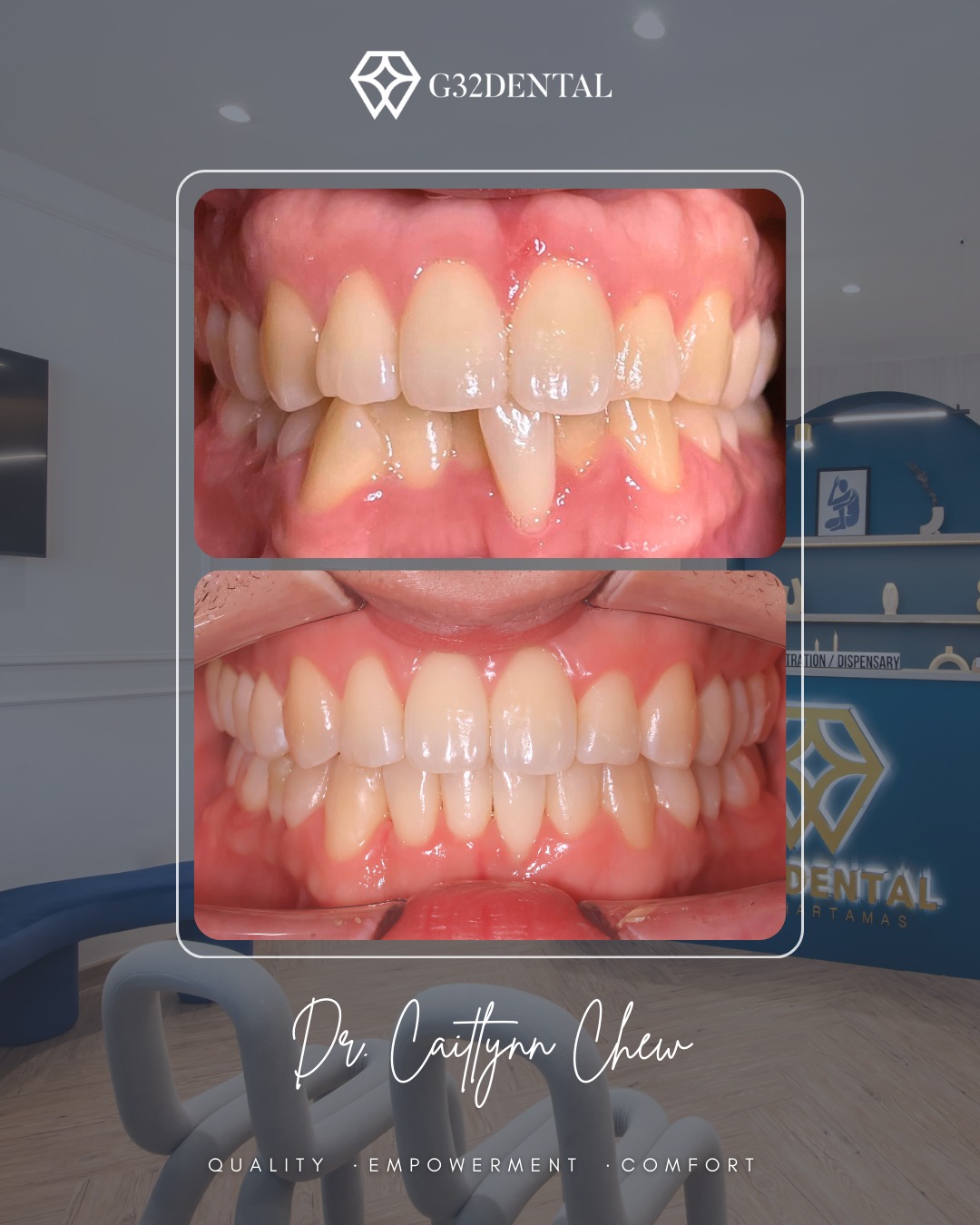 G32 Dental Facebook ad: Non-extraction Invisalign Journey