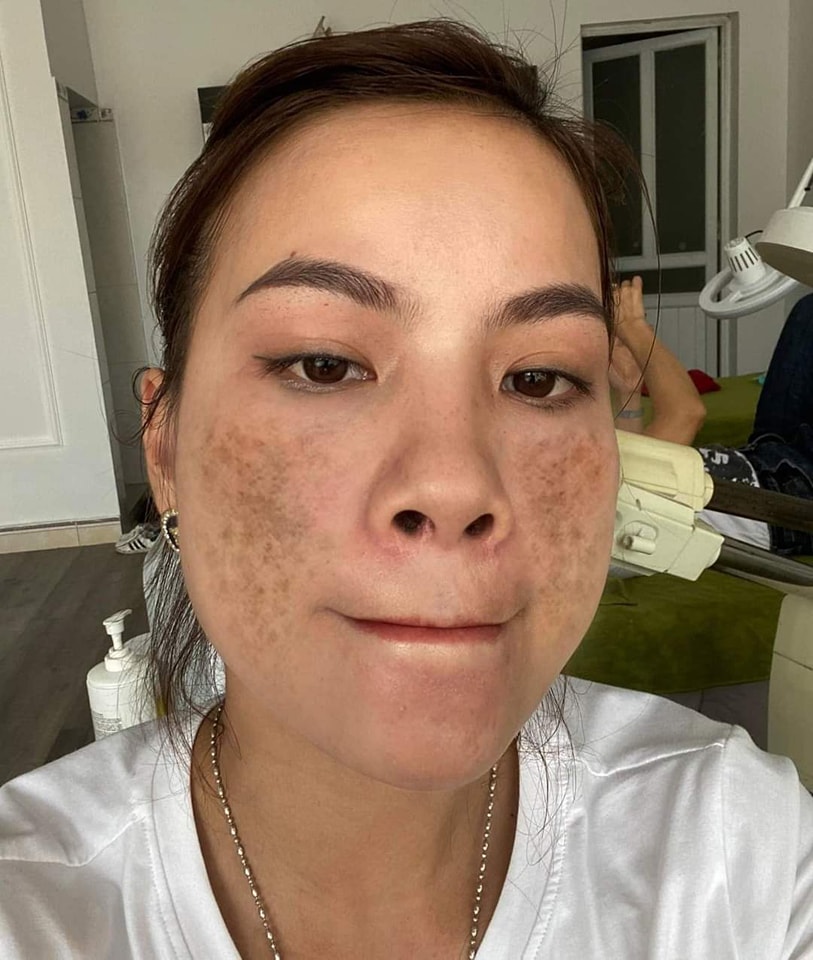 Collagen Original - Tanggal Pekas at Melasma Facebook ad: Solusyon sa Makapal na PEKAS, Mura at Sobrang…