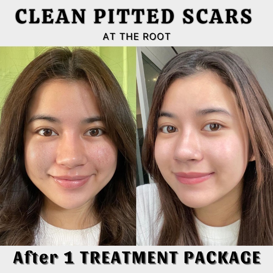 Nado Clinic Facebook ad: HOW LONG DOES IT TAKE TO CLEAN ACNE…