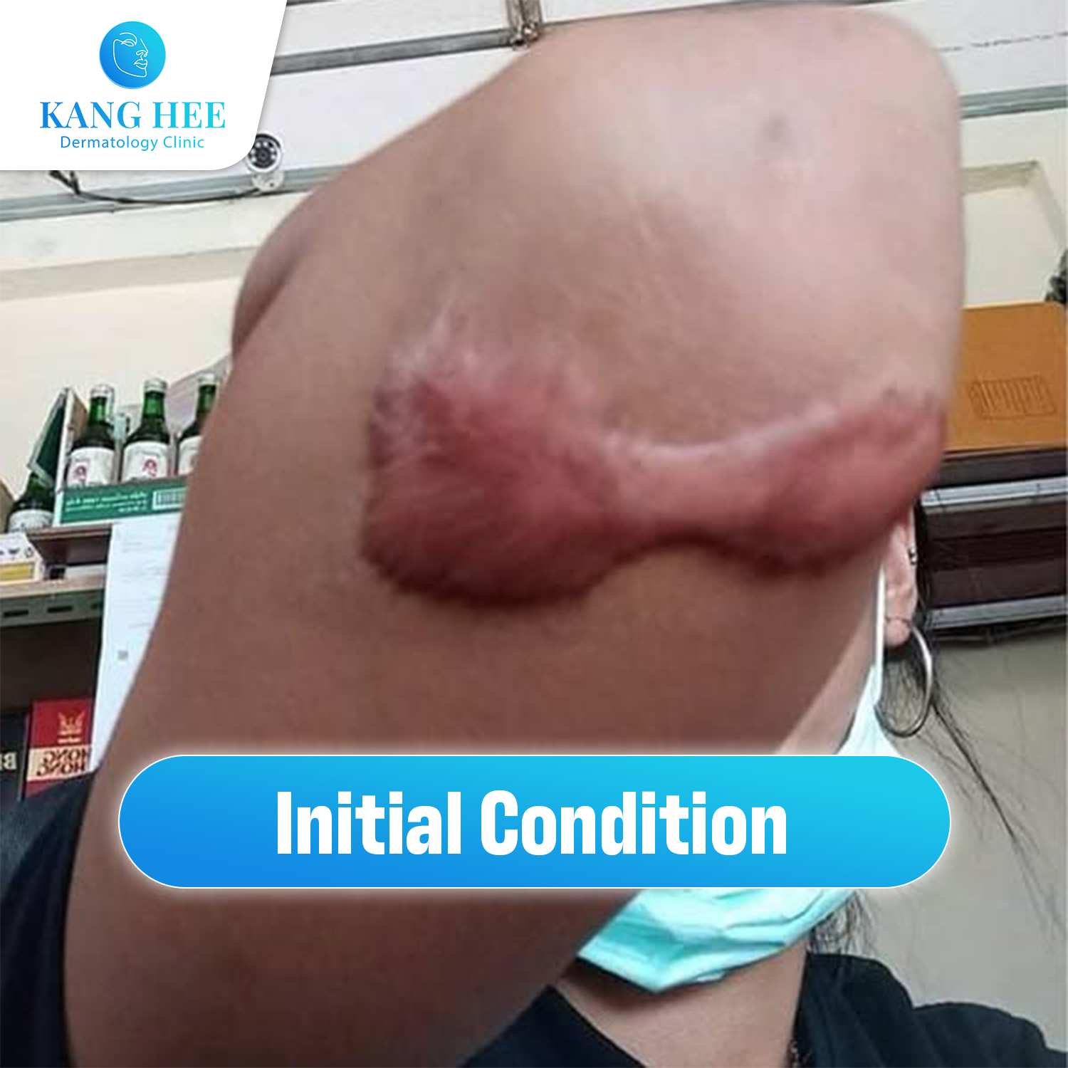 Kanghee International Aesthetic Institute - Dubai City Facebook ad: ERASE KELOIDS WITH EXO SCAR: NON-SURGICAL, PAINLESS…