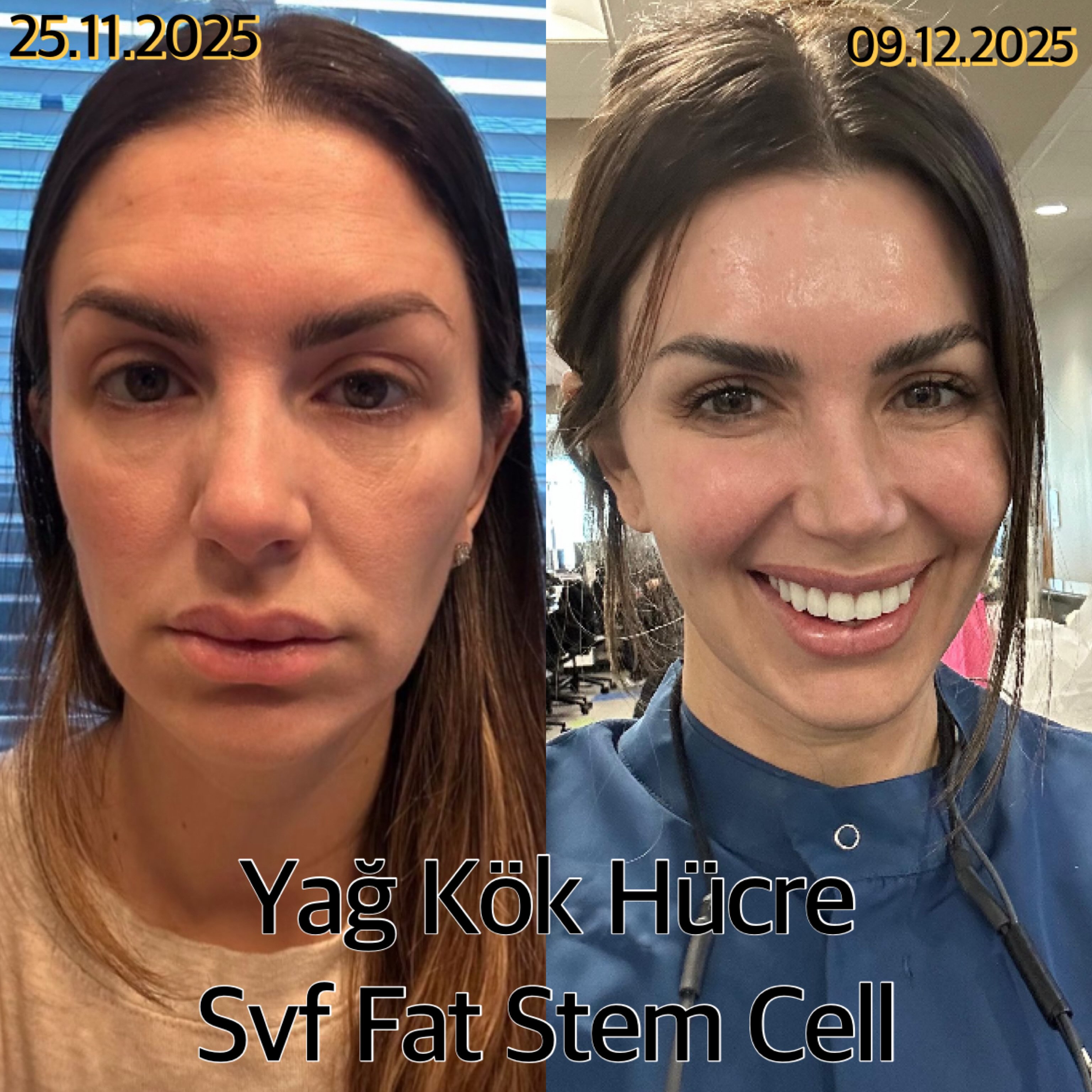 Dr.Abdullah Ünal Facebook ad: SVF Kök Hücre ile Doğal Yüz Gençleştirme